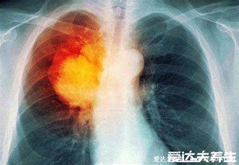 肺癌晚期临终前三天8大症状，这些你应该都清楚才对